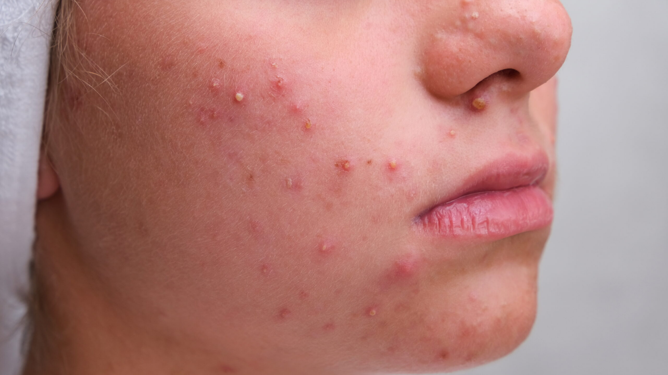 Teen acne explained: When you should visit a dermatologist for timely treatment