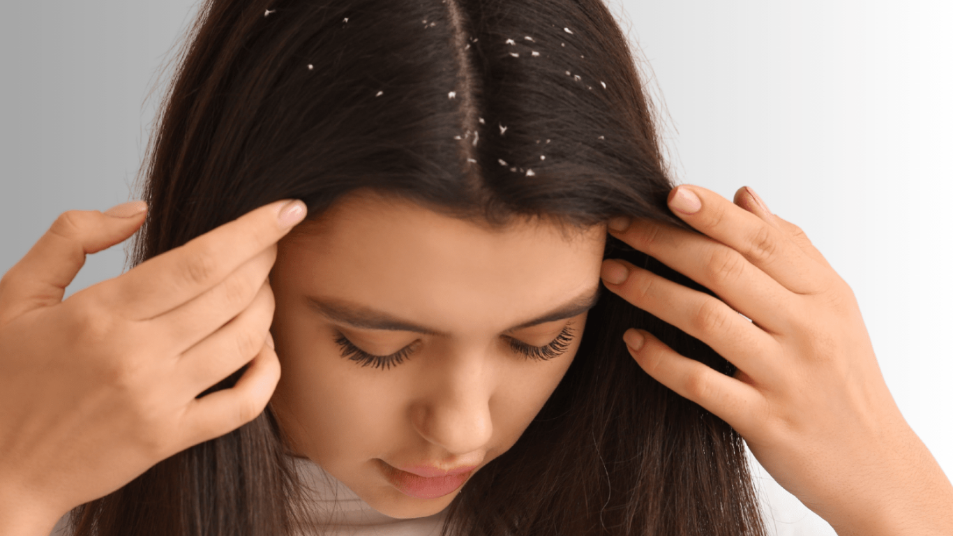Dermatologist explains why winter dandruff and hair fall increase and how to treat them effectively